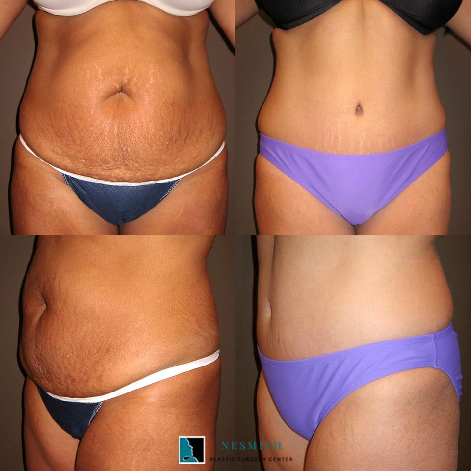Tummy tuck body contouring 4