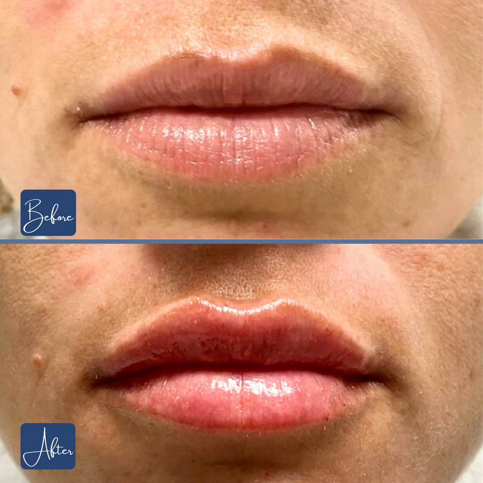 Lips 20