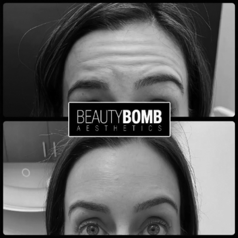 Botox beautybombaesthetics01bw