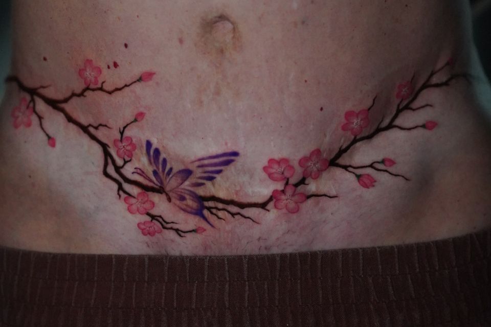 Tummy tuck 1