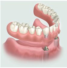 Implant-supported Dentures | Smileworks Meridian Idaho
