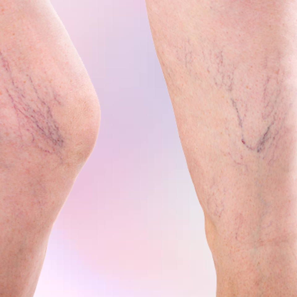 Spider Vein Treatment