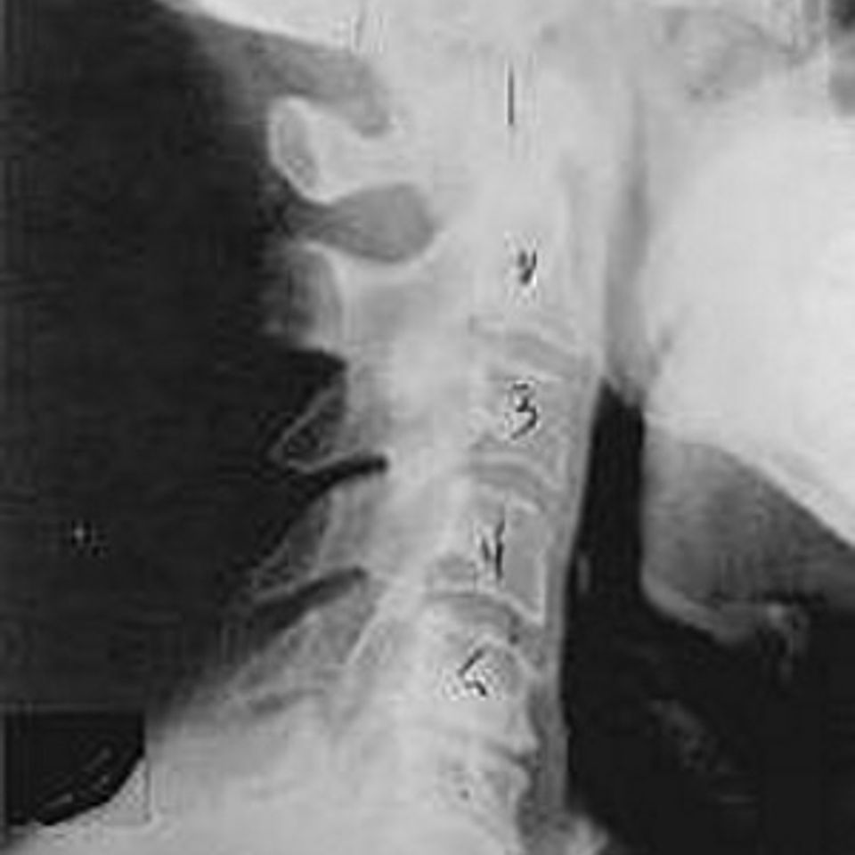 Subluxation phase two