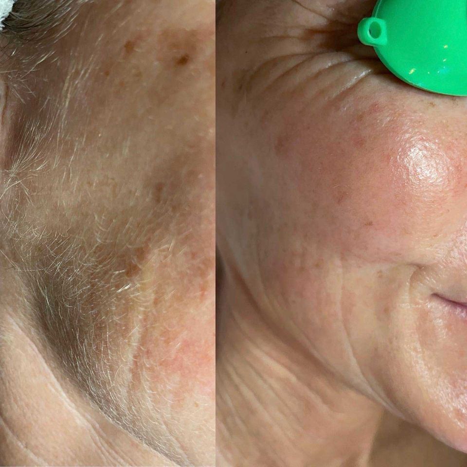 Dermaplaning before after