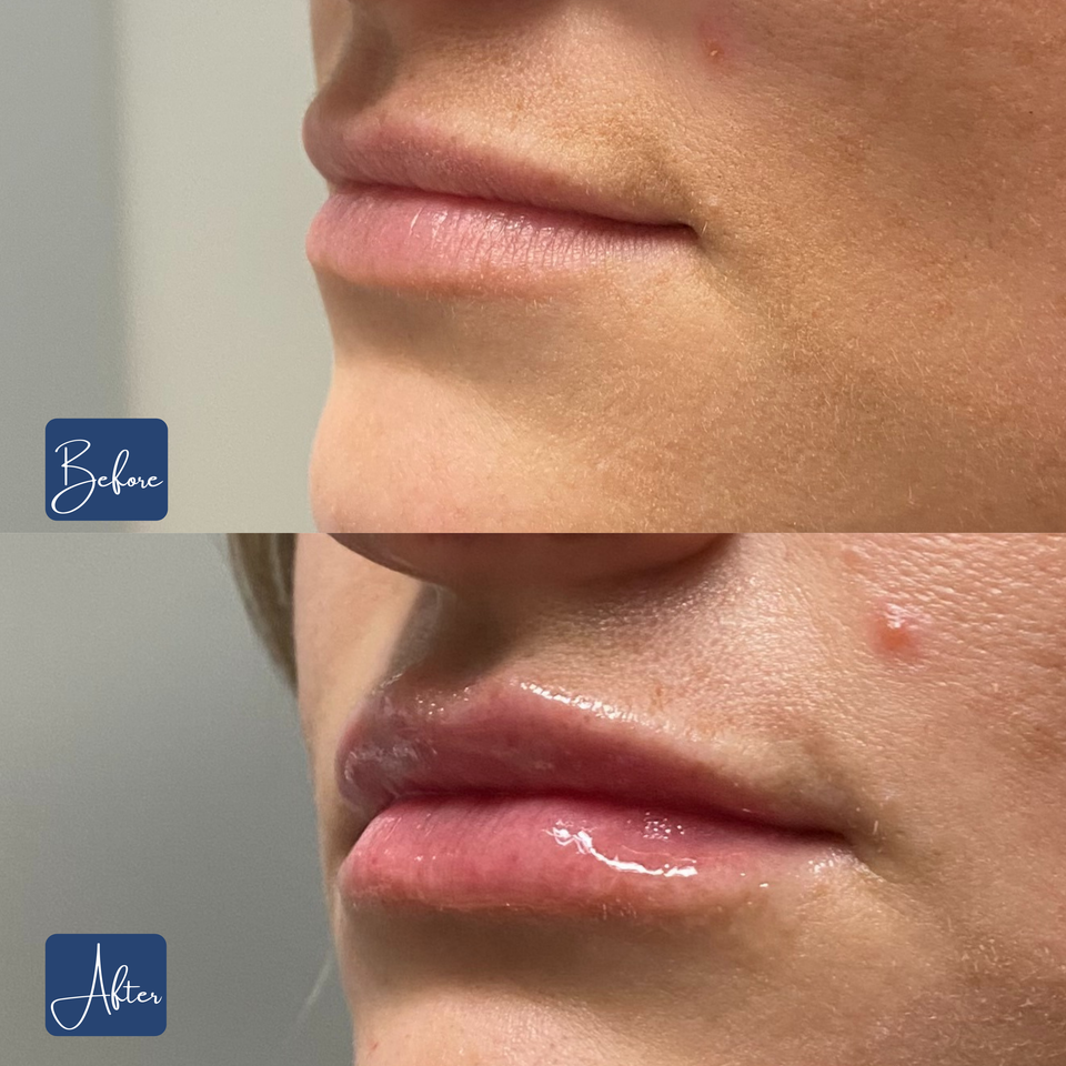 Lips 13