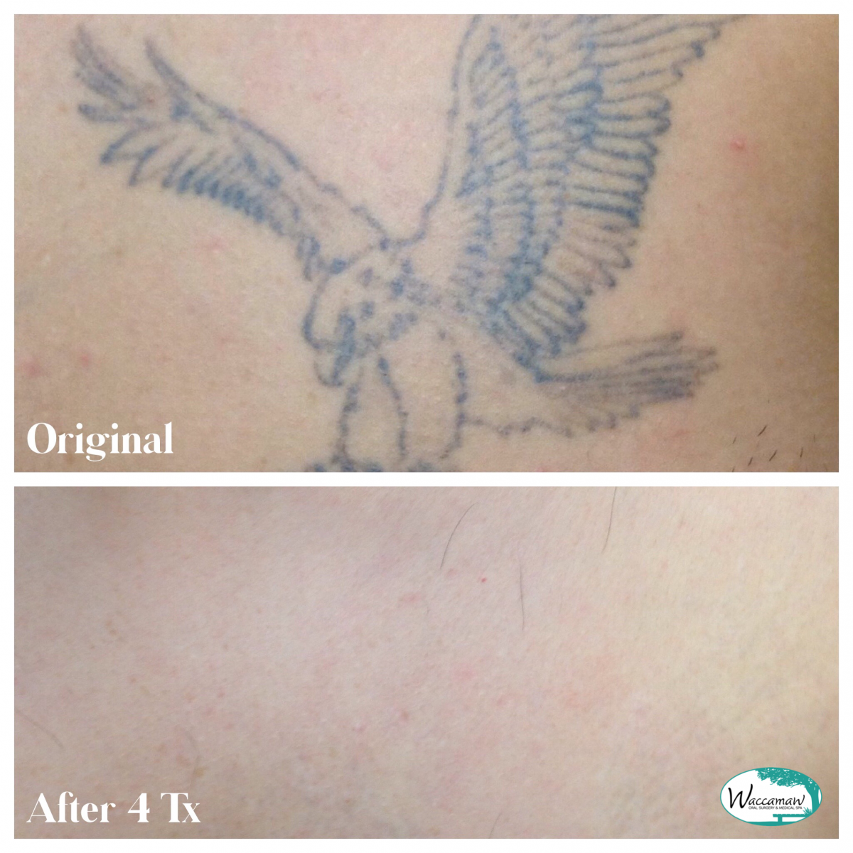 tattoo removal healed resultsTikTok Search