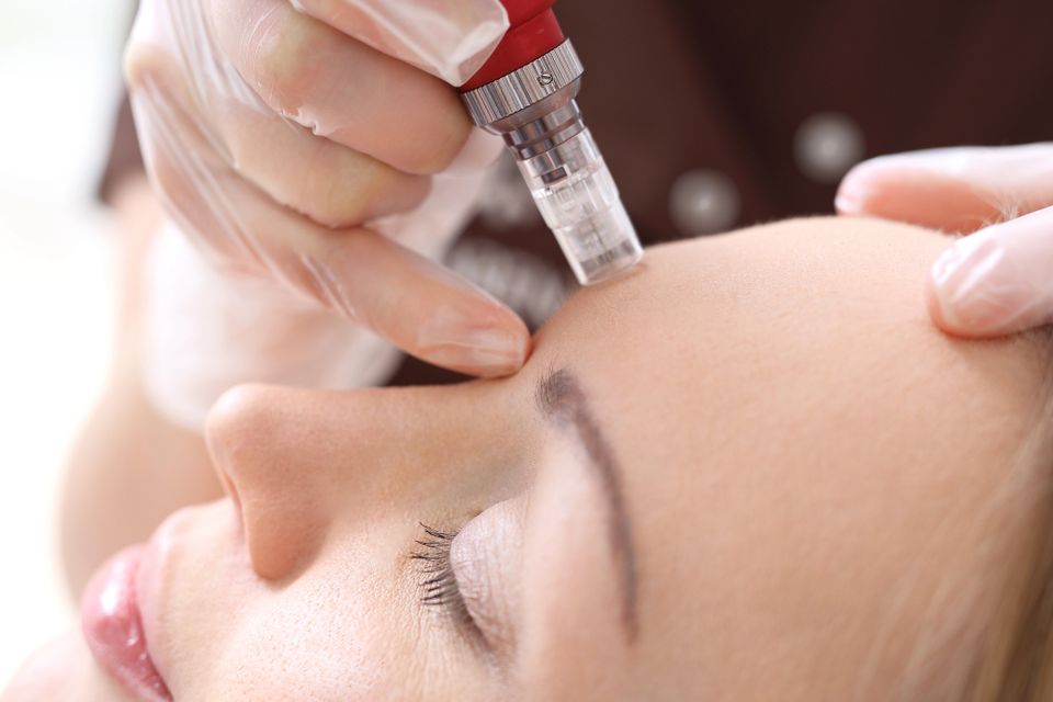 Microneedling lone pine dermatology