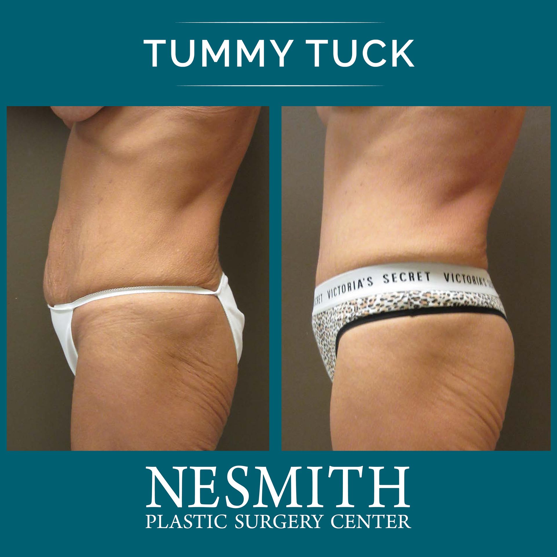 Tummy Tuck Miami - The Secret Plastic Surgery