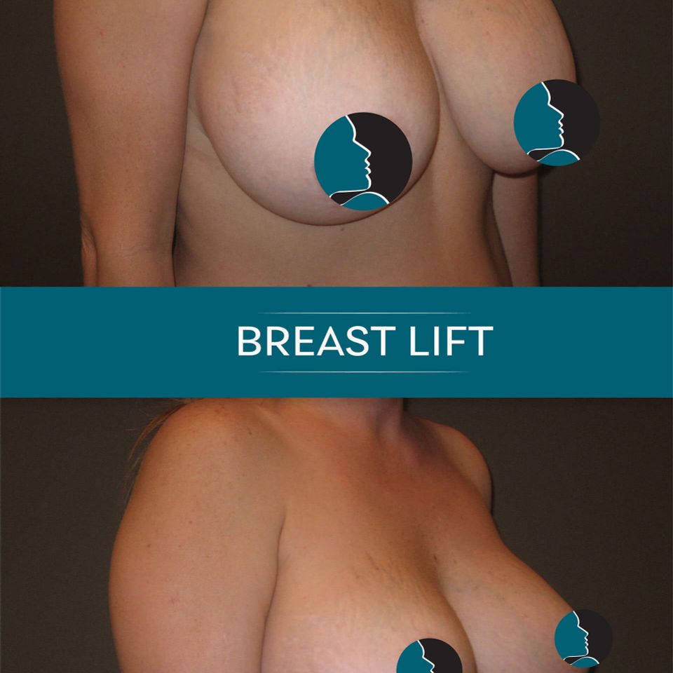 Nps social breasts lift 08