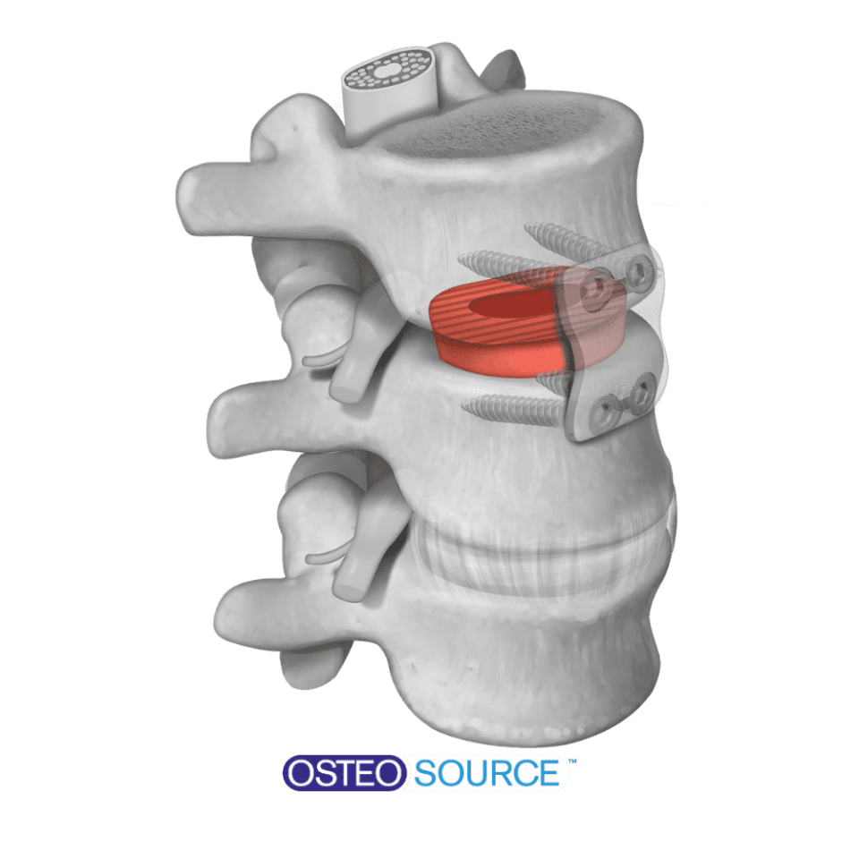 5 osteo source