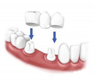 Bridges, Implants or Dentures in Meridian Idaho