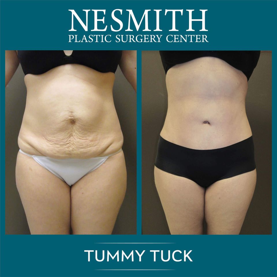 Nps social tummy 03