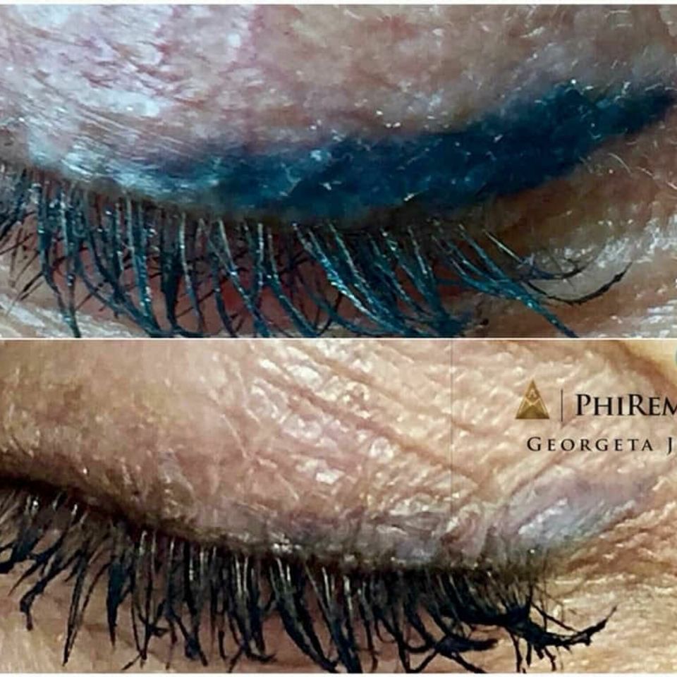 Phiremoval 7