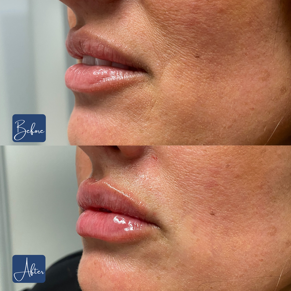 Lips 18