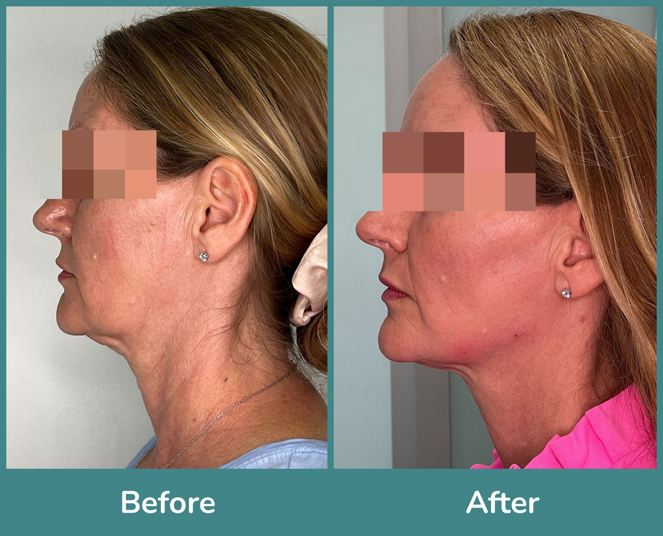 Before after 10