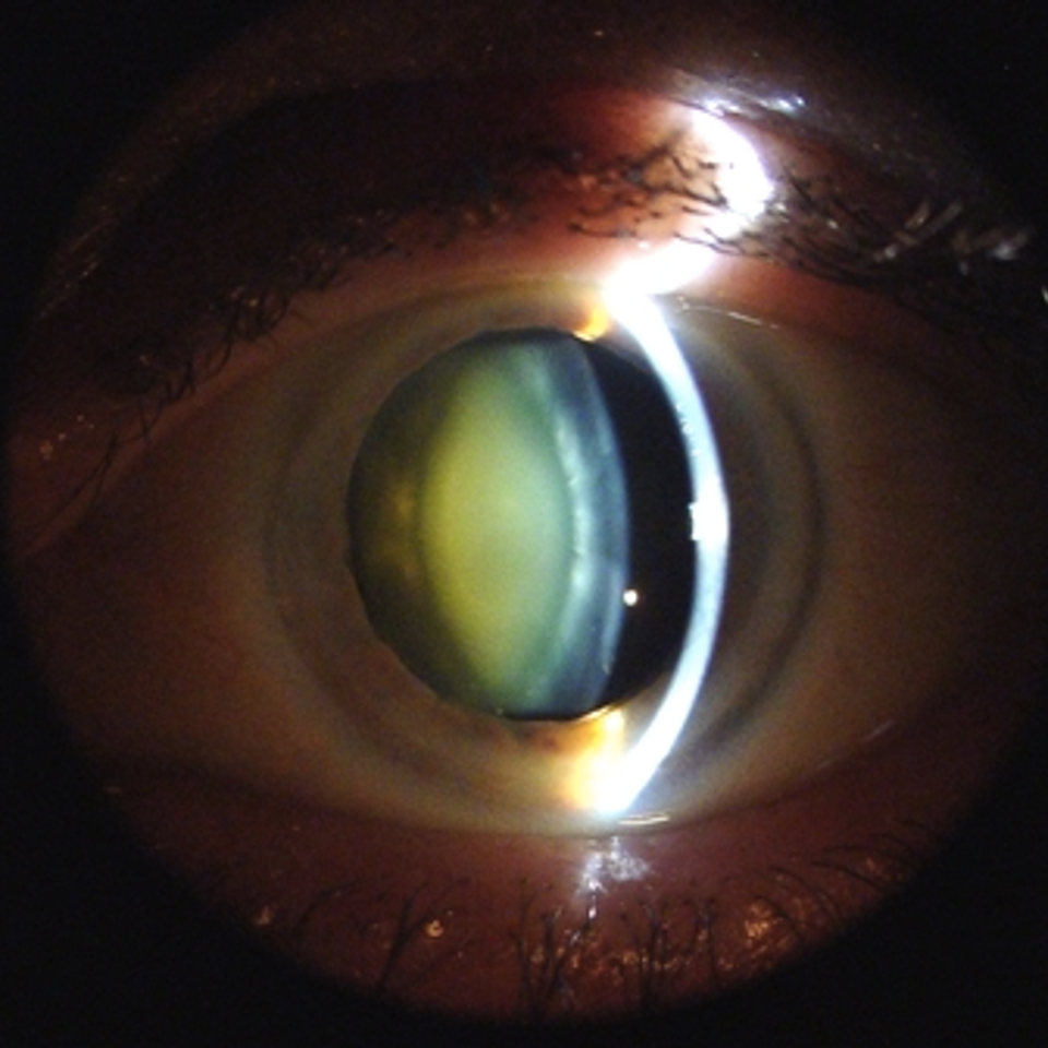 Cataractglareblurredvisionblurryoptometryoptometricoptometristvisualvisioneyecareeyeserviceeyedoctoracuvueoasysbiofinityseaeyecarechicksbeacheasteachoceanviewshoredrive2351823505norfolkvirginiabeachvavbchesapeakebayhamptonroadstidewater