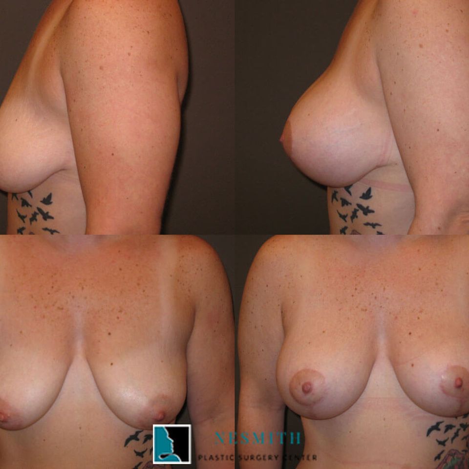Breast lift mastopexy 1