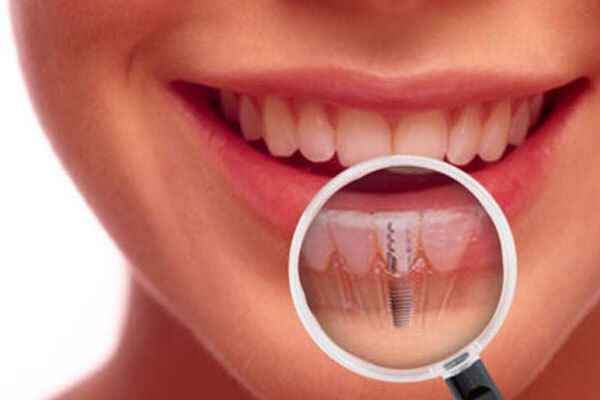 Meridian, Idaho Dental Implants