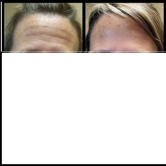 Forehead botox