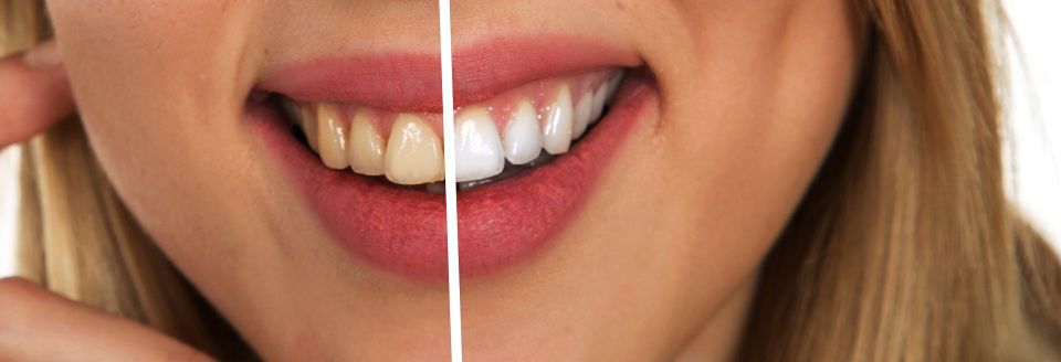 Porcelain Veeners in Meridian Idaho