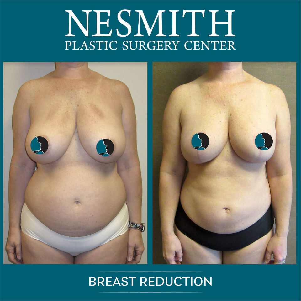 Nps social breasts red 12