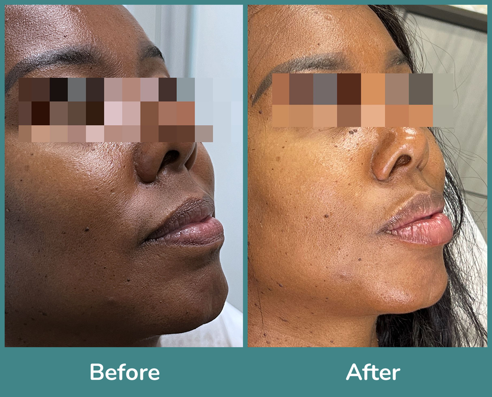 Before after 2
