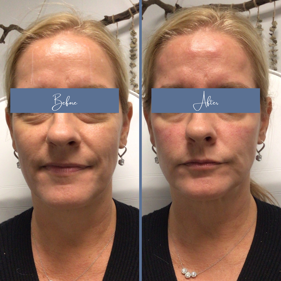 Botox 4