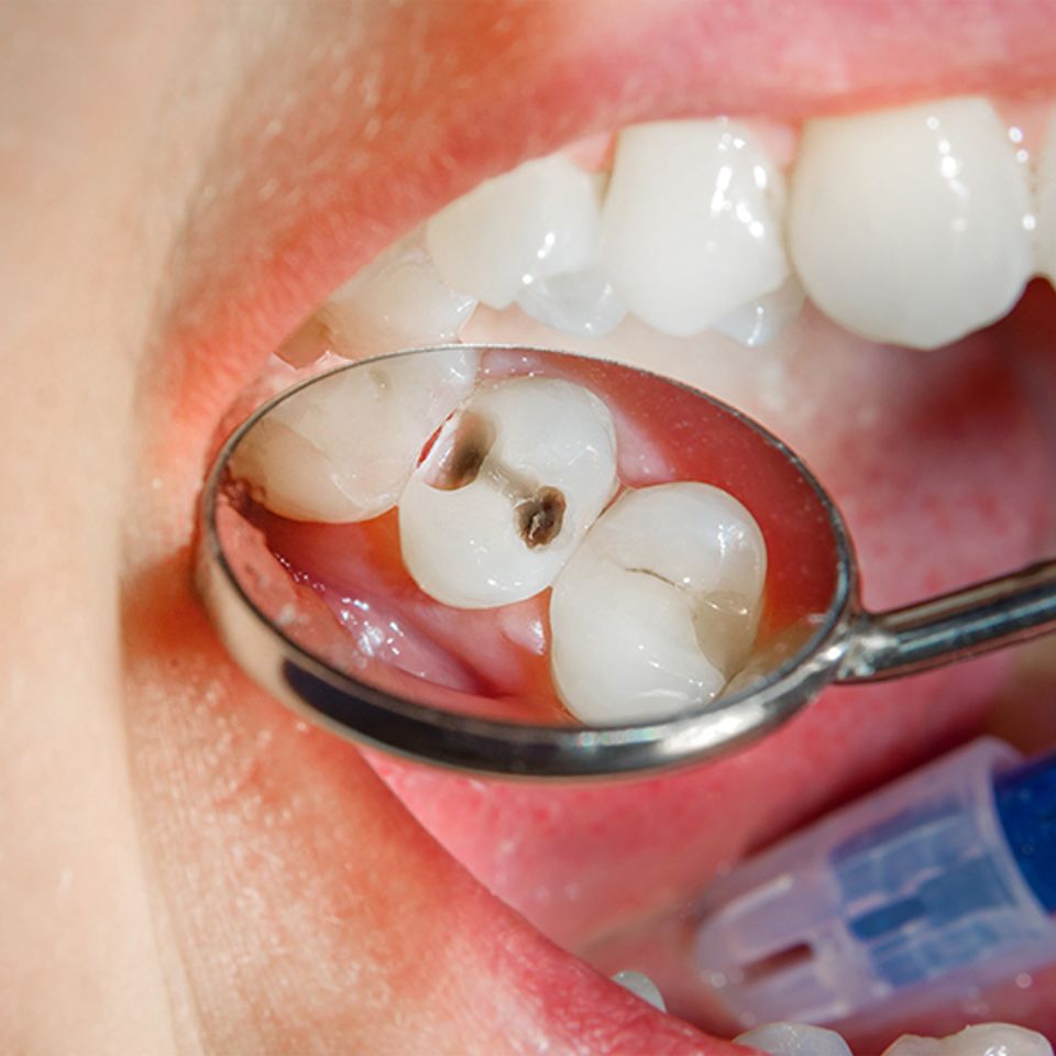 Humbert road dentistry cavities