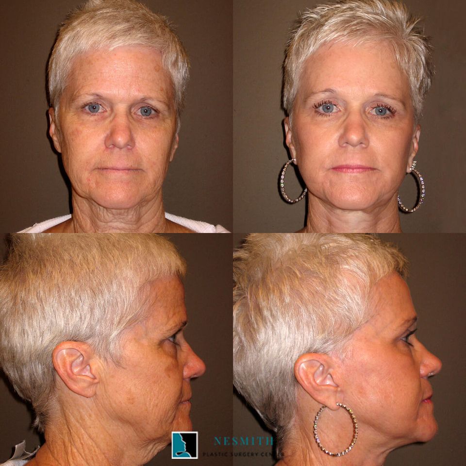 Facelift rhytidectomy 2