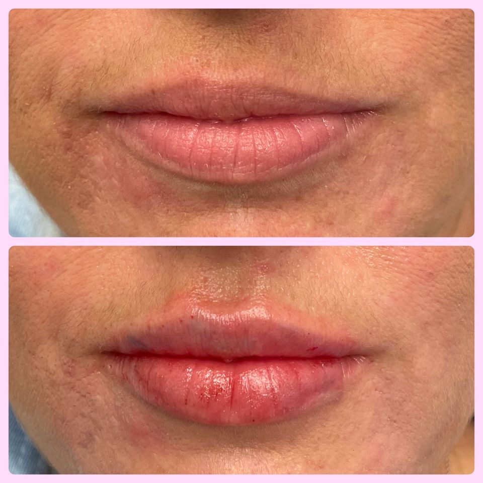 Lip filler beauty bomb aesthetics