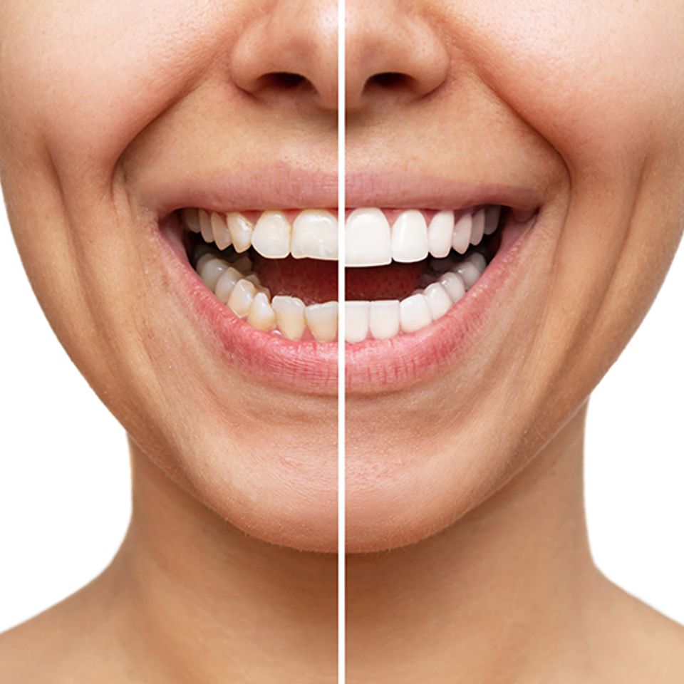 Humbert road dentistry crowns