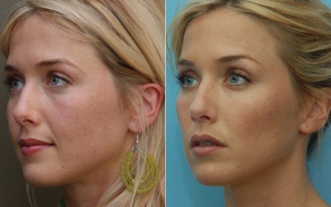 Before and after