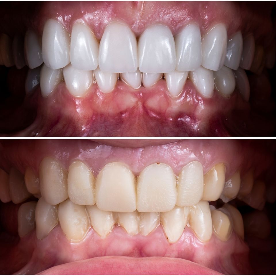  before n after veneer