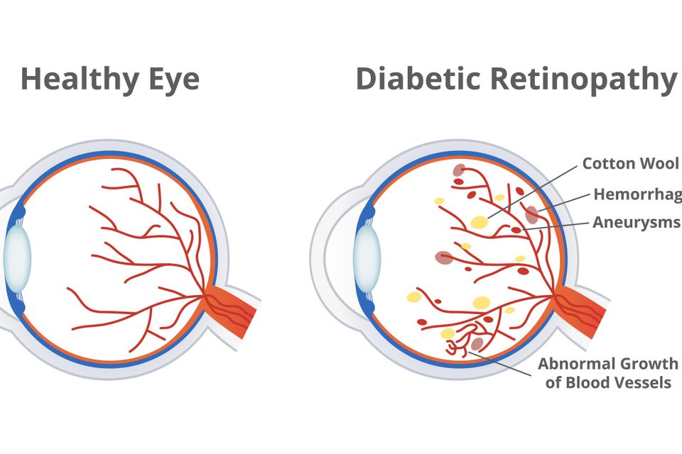 Diabeticret