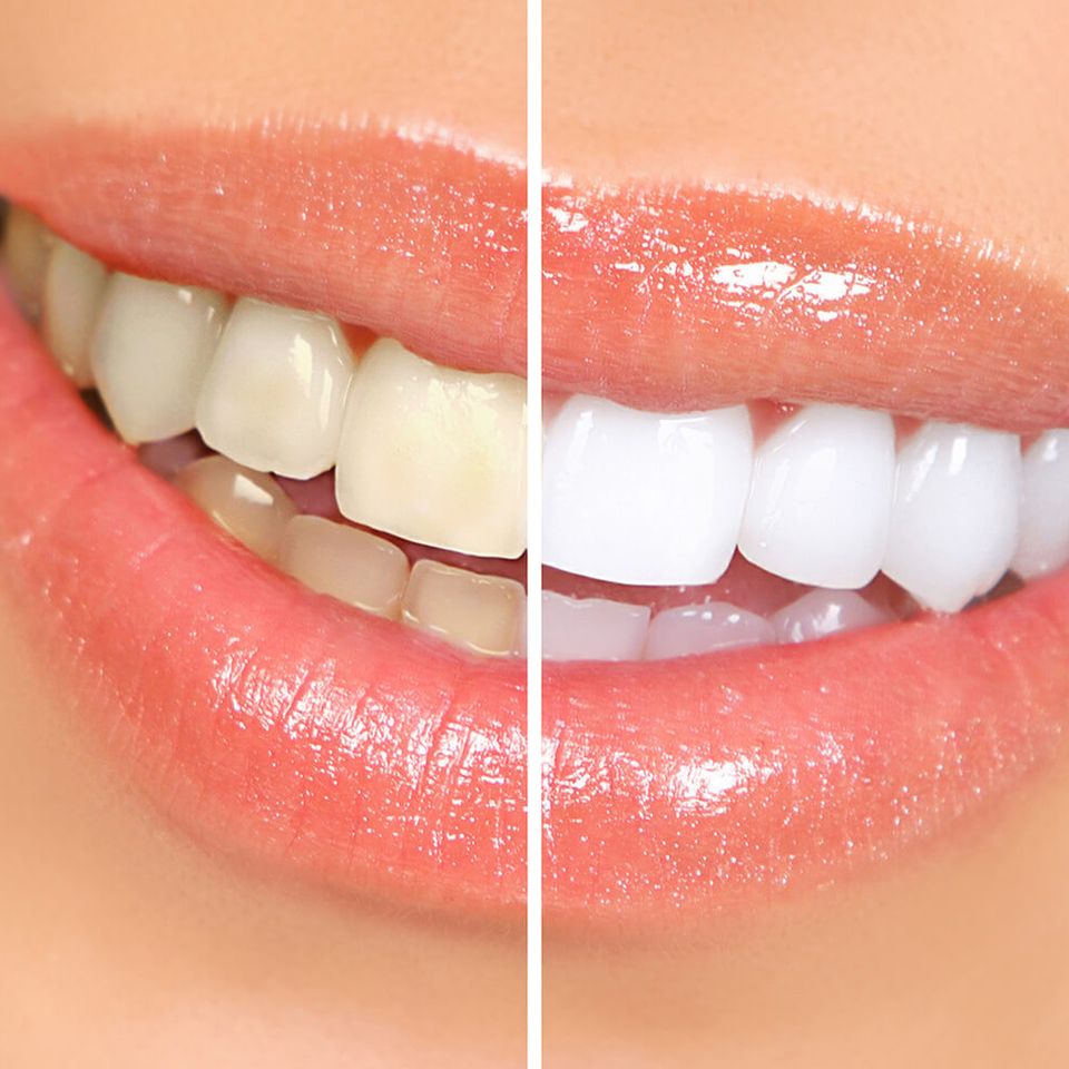 Humbertroaddentistry teethwhitening