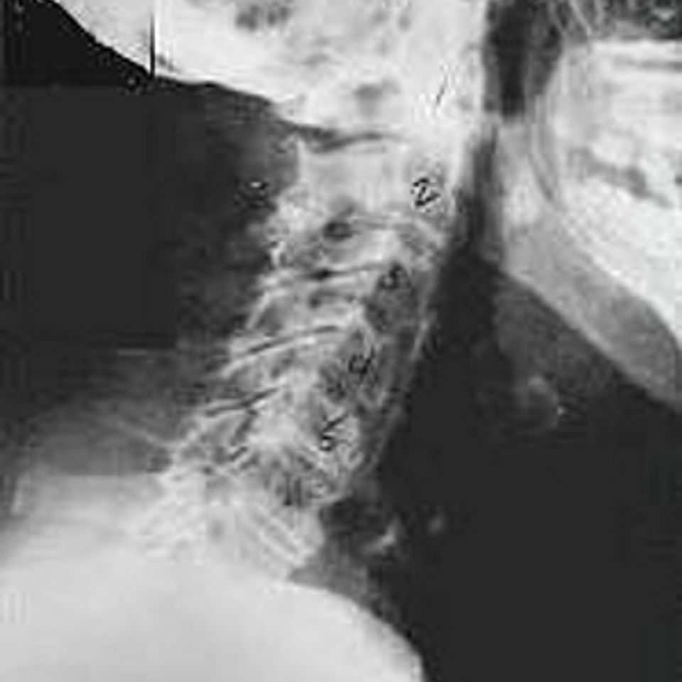 Subluxation phase four