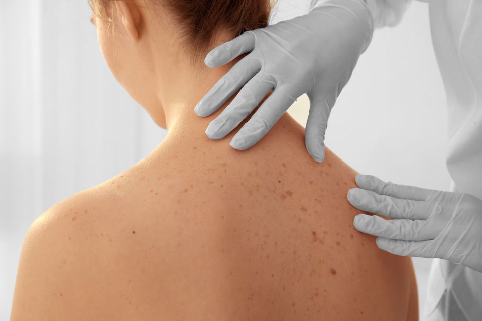Skin Cancer Screening