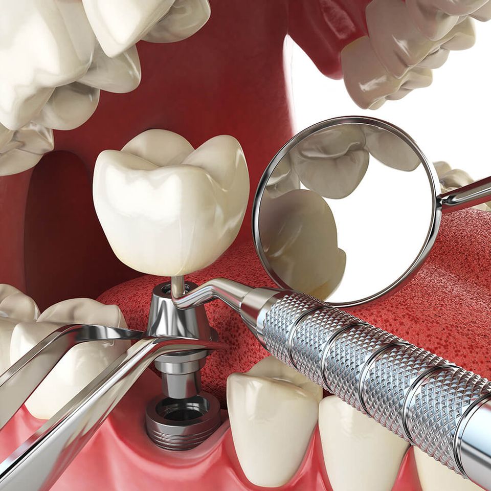 Humbertroaddentistry dentalimplant