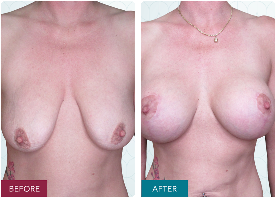 Case 2 breast augmentation