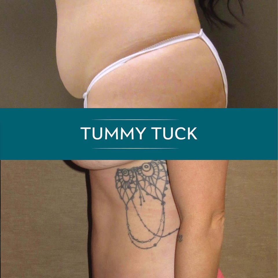 Nps social tummy 01