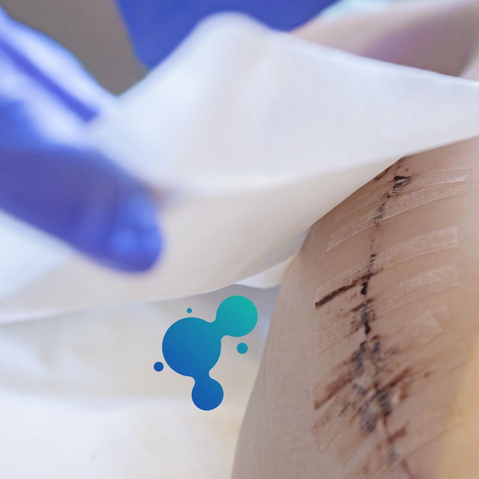 Fusion Biologics amniotic skin graft applied to healing wound for tissue regeneration.