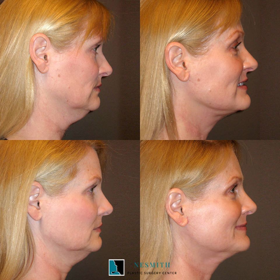Facelift rhytidectomy 3
