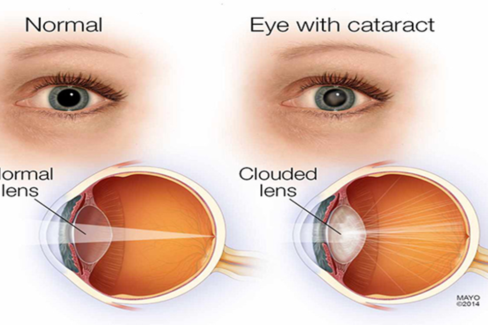 Cataract