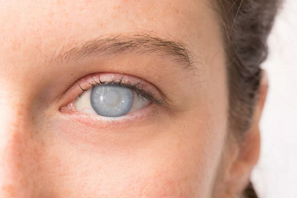Woman cataract eye jpg webp