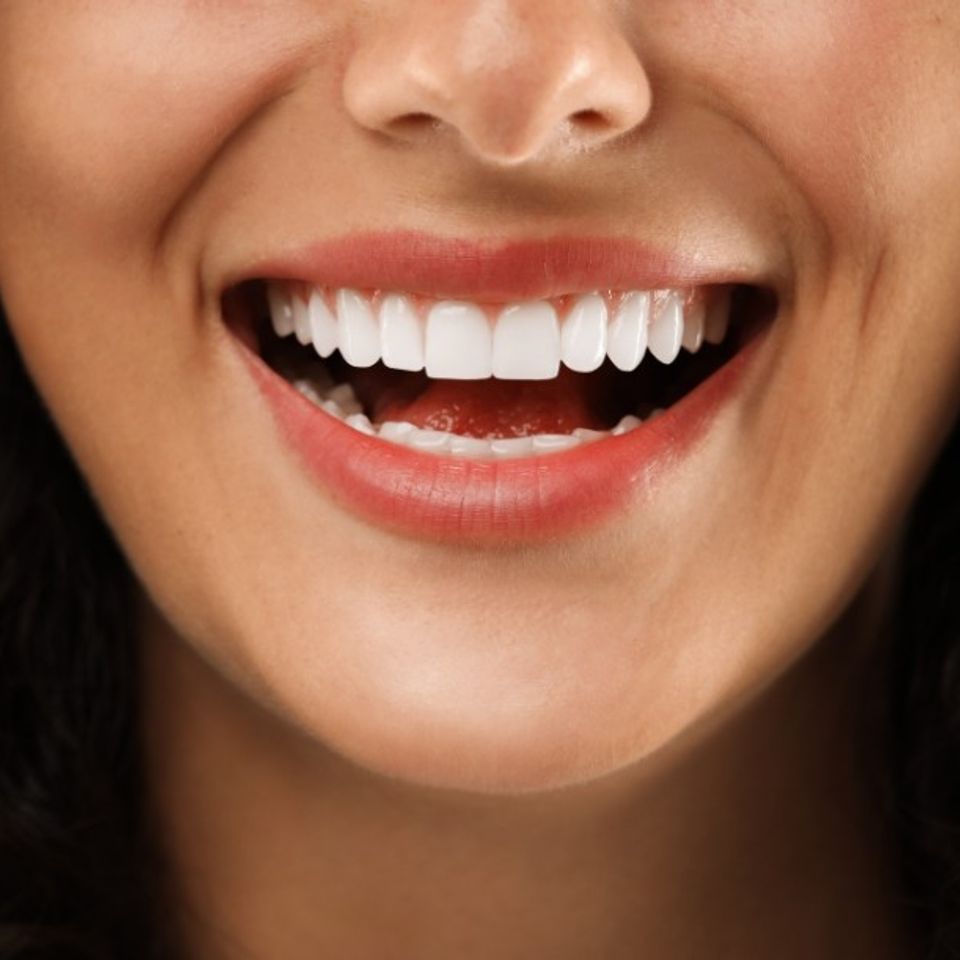 Veneer smile
