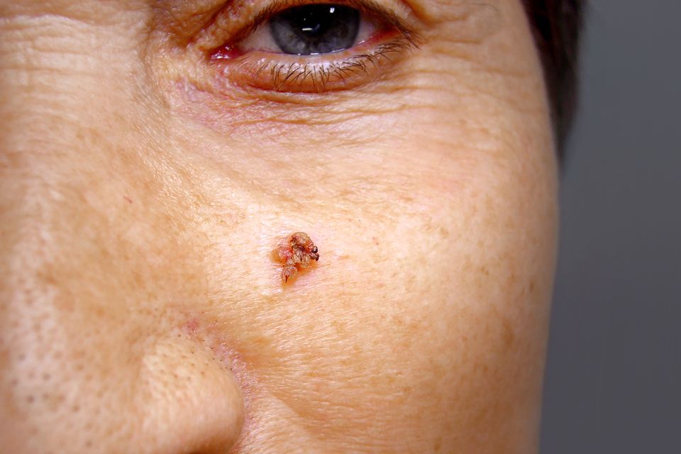 Facial melanoma
