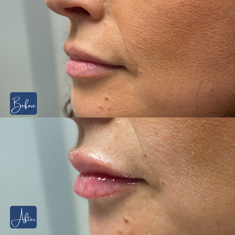Lips 10