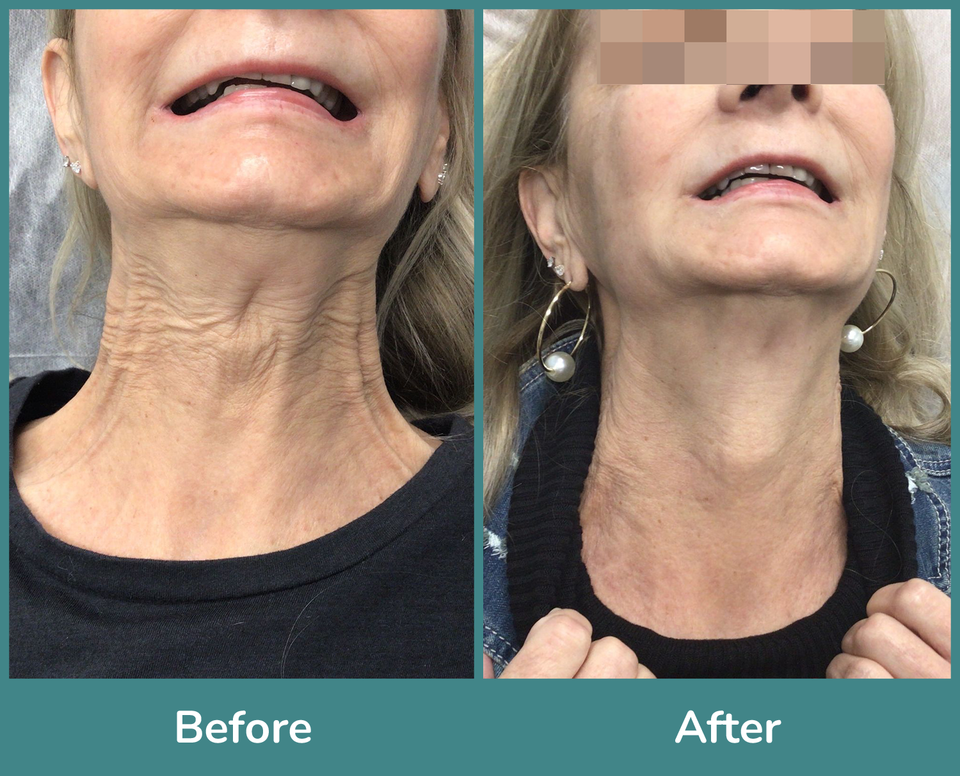 Before after 8
