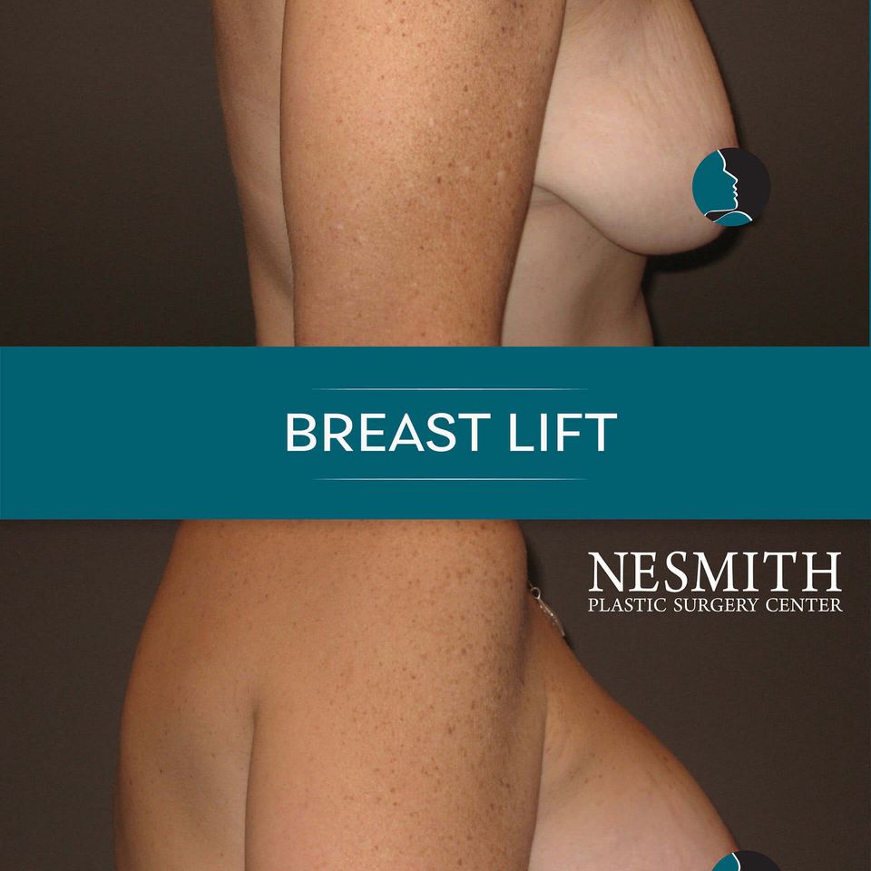 Nps social breasts lift 07