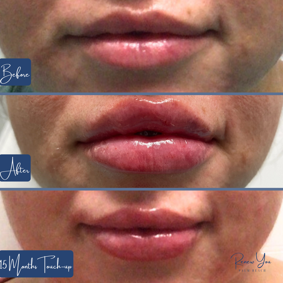 Lips 5